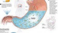 Gelesis公司膨脹劑Gelesis100的早期臨床結(jié)果出爐，這也算減肥藥？